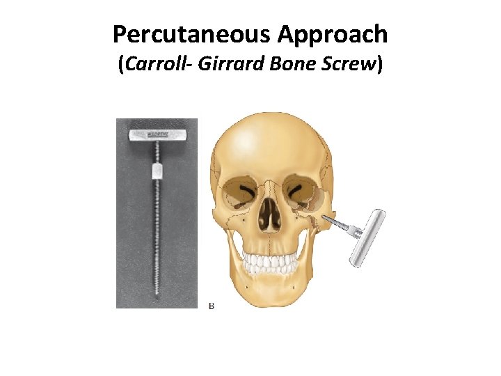 Percutaneous Approach (Carroll- Girrard Bone Screw) 