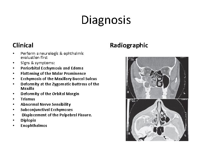 Diagnosis Clinical • • • • Perform a neurologic & ophthalmic evaluation first Signs