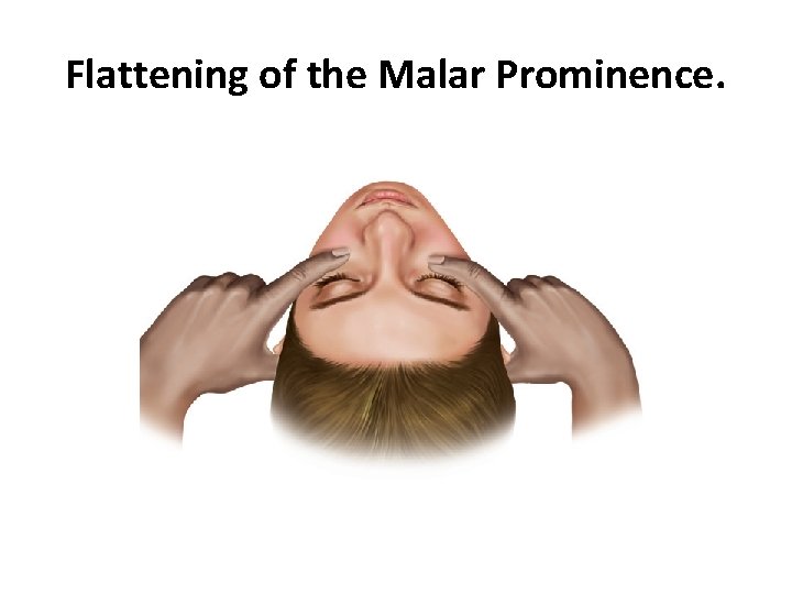 Flattening of the Malar Prominence. 