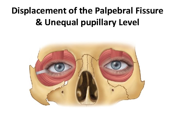 Displacement of the Palpebral Fissure & Unequal pupillary Level 