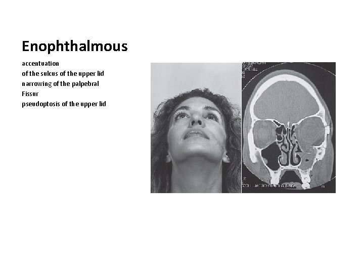 Enophthalmous accentuation of the sulcus of the upper lid narrowing of the palpebral Fissur