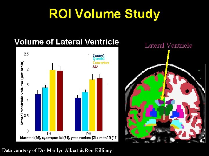 ROI Volume Study Volume of Lateral Ventricle Control Questbl Converters AD Data courtesy of