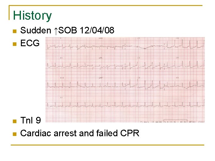 History n n Sudden ↑SOB 12/04/08 ECG Tn. I 9 Cardiac arrest and failed