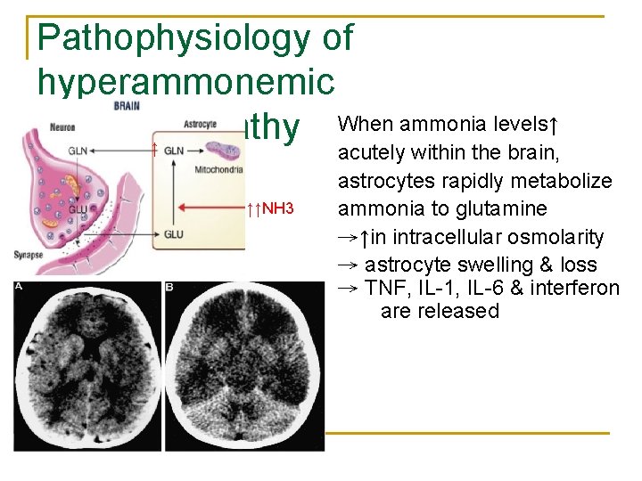 Pathophysiology of hyperammonemic When ammonia levels↑ encephalopathy ↑ ↑↑NH 3 acutely within the brain,