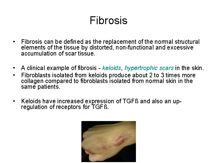 Fibrosis • Fibrosis can be defined as the replacement of the normal structural elements