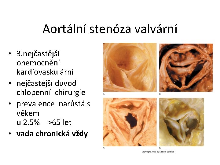 Aortální stenóza valvární • 3. nejčastější onemocnění kardiovaskulární • nejčastější důvod chlopenní chirurgie •