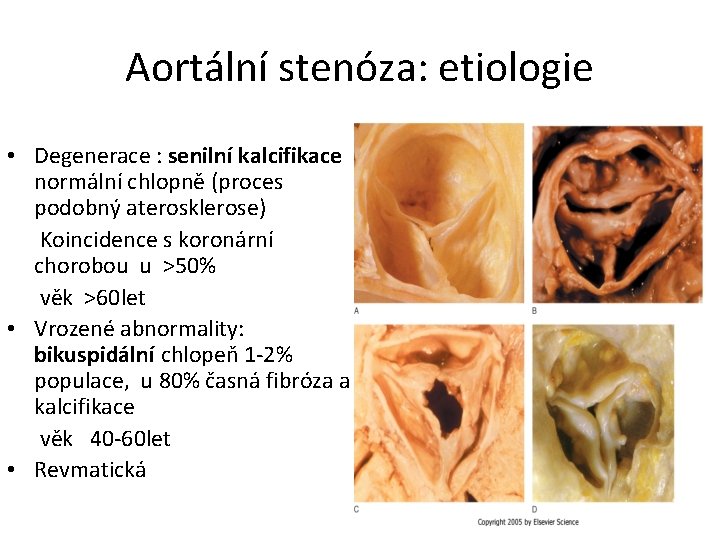 Aortální stenóza: etiologie • Degenerace : senilní kalcifikace normální chlopně (proces podobný aterosklerose) Koincidence