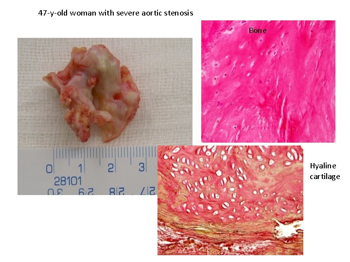 47 -y-old woman with severe aortic stenosis Bone Hyaline cartilage 