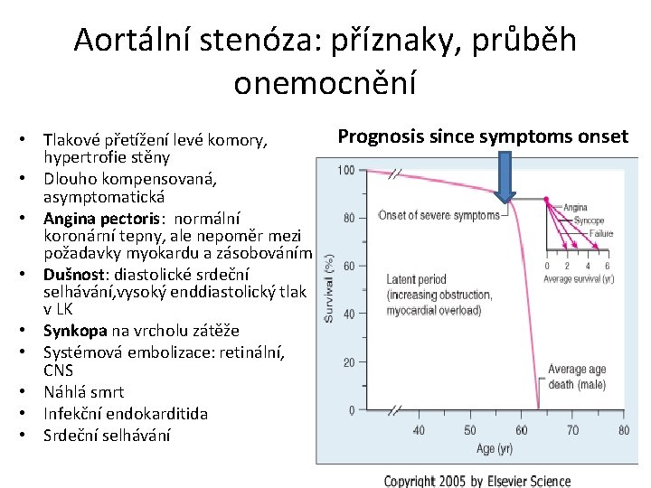 Aortální stenóza: příznaky, průběh onemocnění • Tlakové přetížení levé komory, hypertrofie stěny • Dlouho