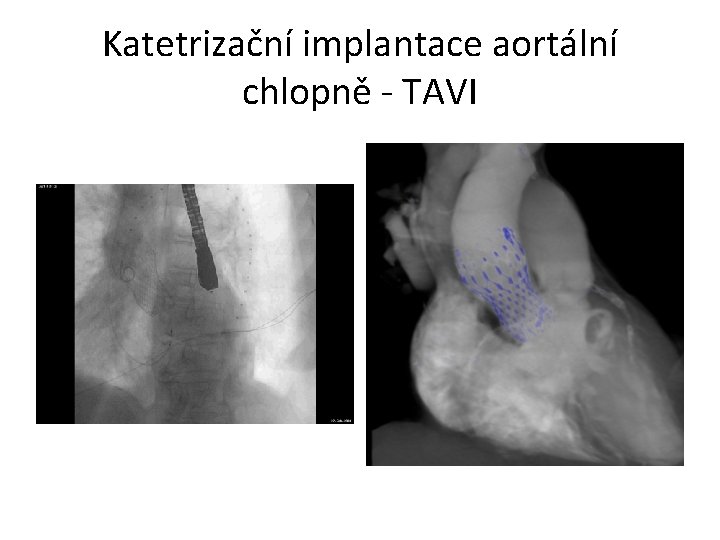Katetrizační implantace aortální chlopně - TAVI 