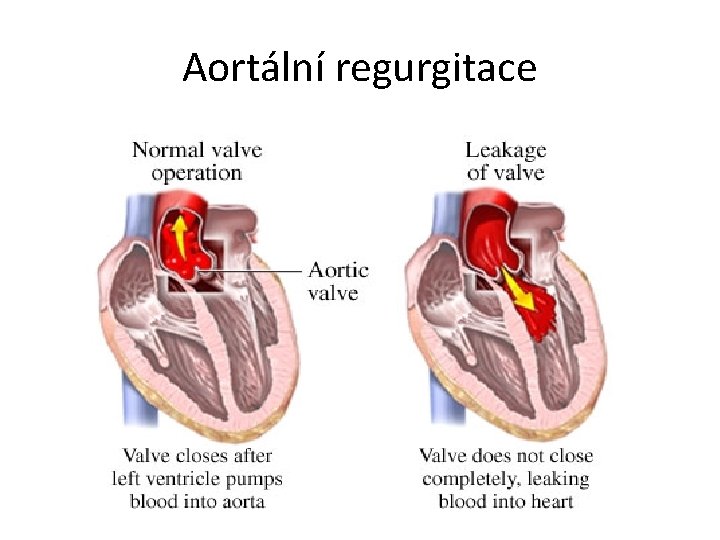 Aortální regurgitace 