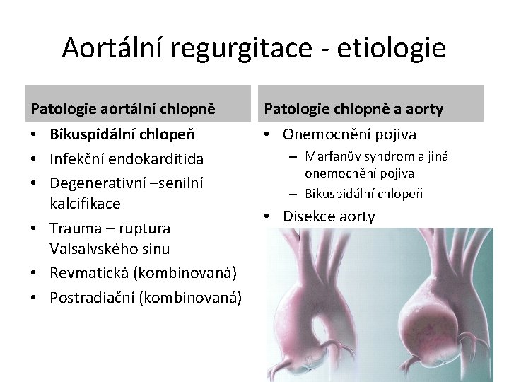 Aortální regurgitace - etiologie Patologie aortální chlopně Patologie chlopně a aorty • Bikuspidální chlopeň