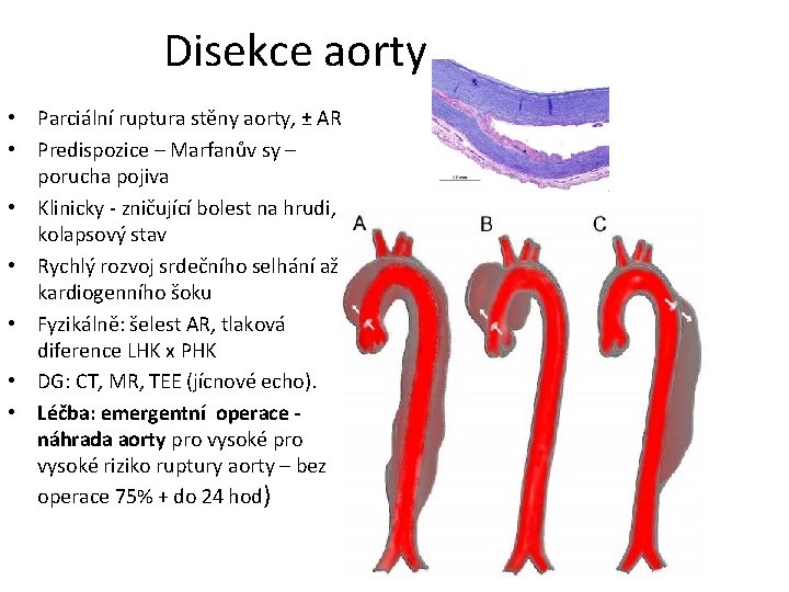 Disekce aorty • Parciální ruptura stěny aorty, ± AR • Predispozice – Marfanův sy