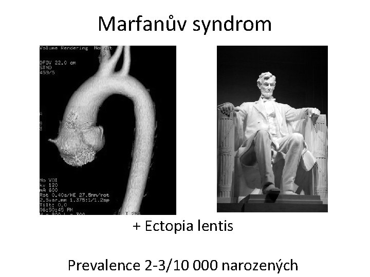 Marfanův syndrom + Ectopia lentis Prevalence 2 -3/10 000 narozených 