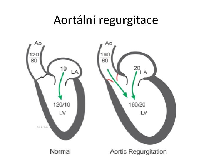 Aortální regurgitace 