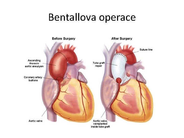 Bentallova operace 