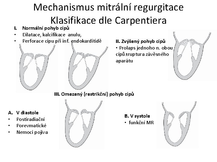 Mechanismus mitrální regurgitace Klasifikace dle Carpentiera I. Normální pohyb cípů • Dilatace, kalcifikace anulu,