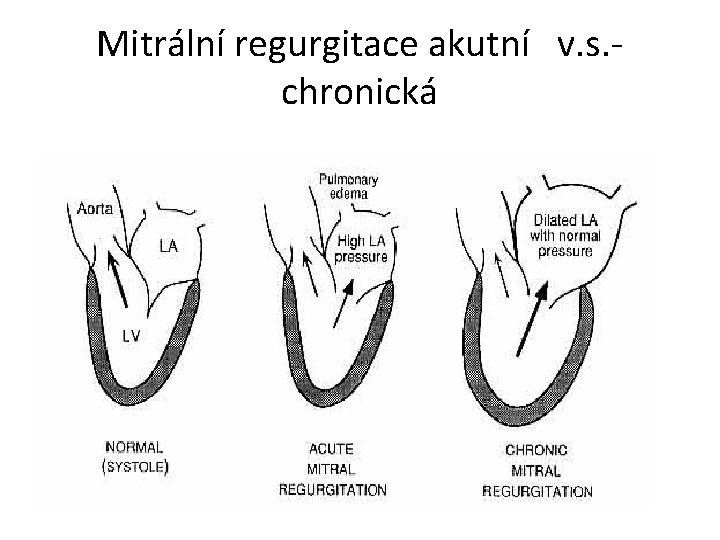 Mitrální regurgitace akutní v. s. chronická 