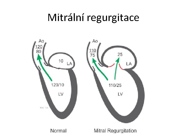 Mitrální regurgitace 