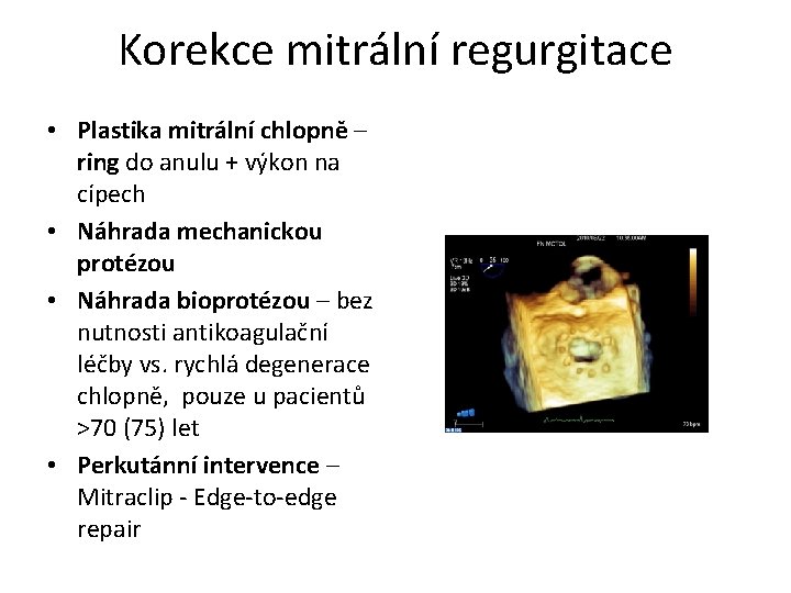 Korekce mitrální regurgitace • Plastika mitrální chlopně – ring do anulu + výkon na