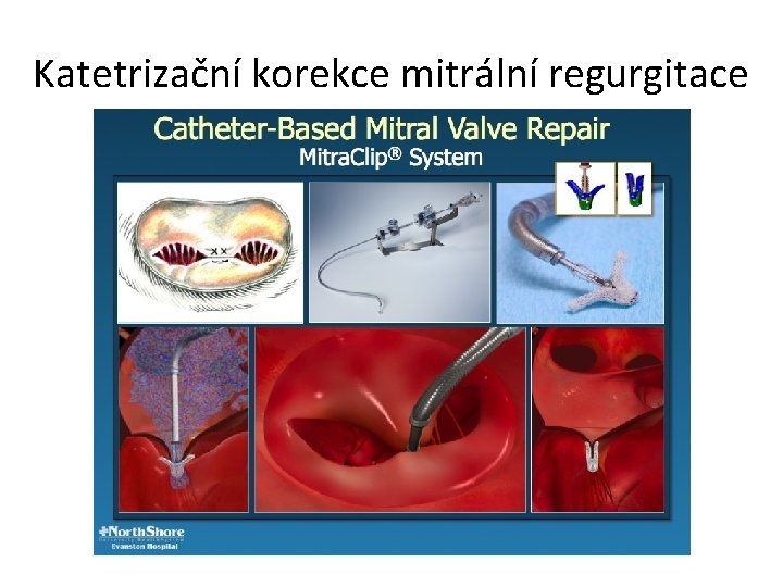 Katetrizační korekce mitrální regurgitace 