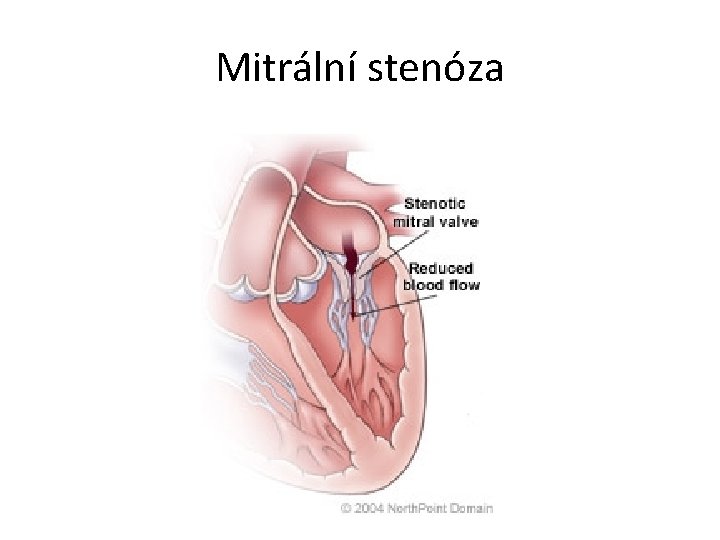 Mitrální stenóza 