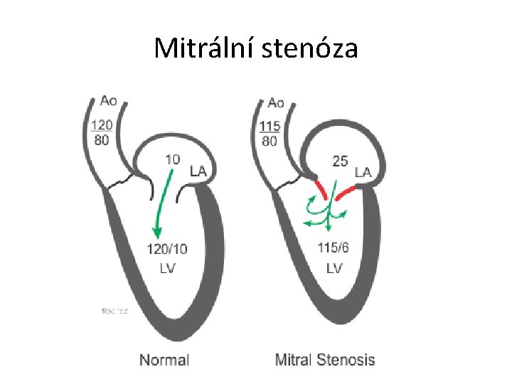 Mitrální stenóza 