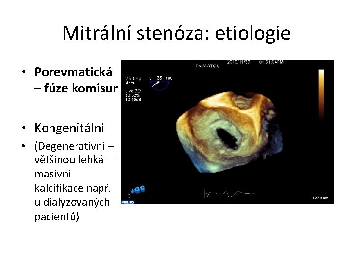 Mitrální stenóza: etiologie • Porevmatická – fúze komisur • Kongenitální • (Degenerativní – většinou