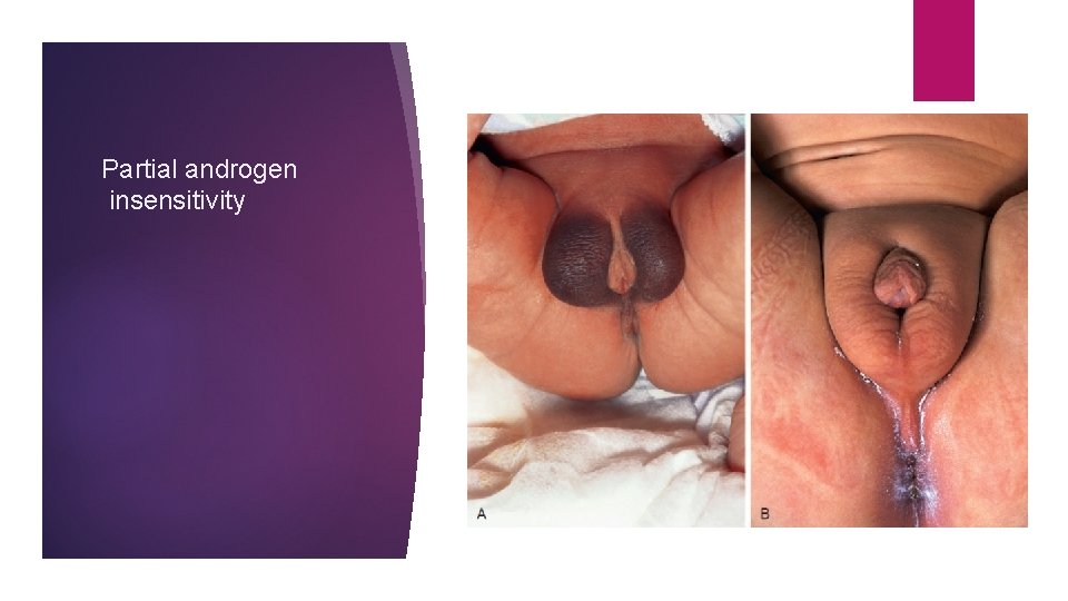 Partial androgen insensitivity 