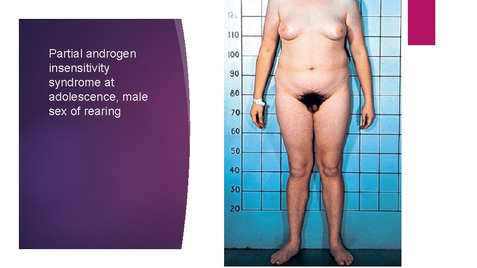 Partial androgen insensitivity syndrome at adolescence, male sex of rearing 