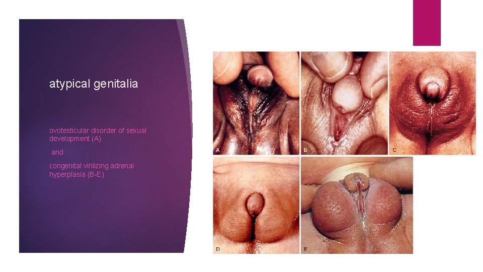 atypical genitalia ovotesticular disorder of sexual development (A) and congenital virilizing adrenal hyperplasia (B-E)