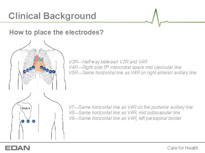 Clinical Background How to place the electrodes? V 3 R---Half way between V 2 Clinical Background How to place the electrodes? V 3 R---Half way between V 2