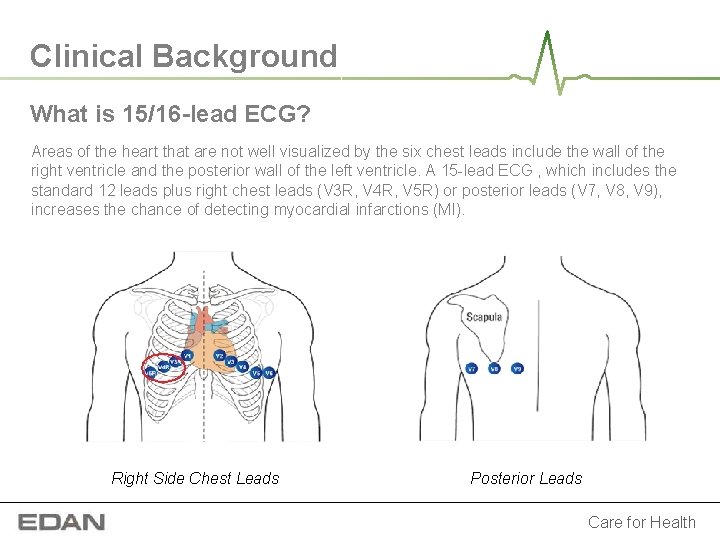 Clinical Background What is 15/16 -lead ECG? Areas of the heart that are not Clinical Background What is 15/16 -lead ECG? Areas of the heart that are not