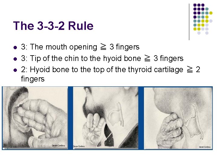 The 3 -3 -2 Rule l l l 3: The mouth opening ≧ 3