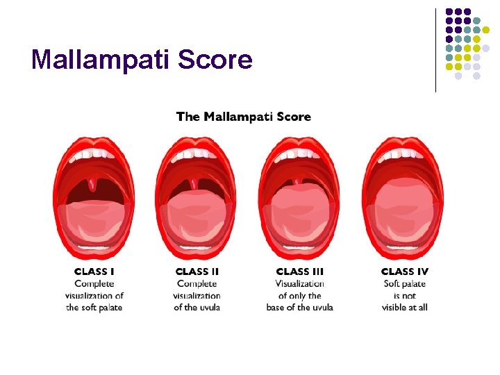 Mallampati Score 