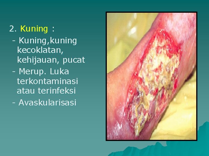 2. Kuning : - Kuning, kuning kecoklatan, kehijauan, pucat - Merup. Luka terkontaminasi atau