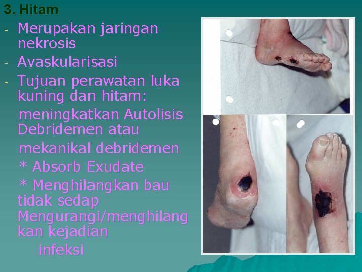 3. Hitam - Merupakan jaringan nekrosis - Avaskularisasi - Tujuan perawatan luka kuning dan