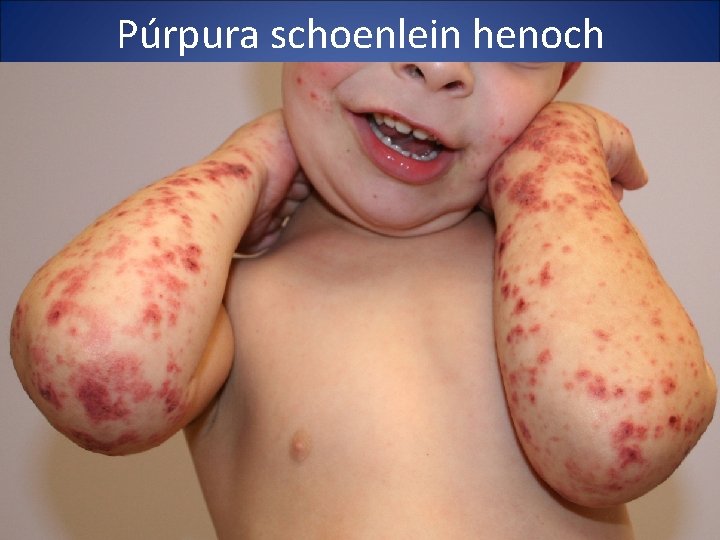 Púrpura schoenlein henoch 