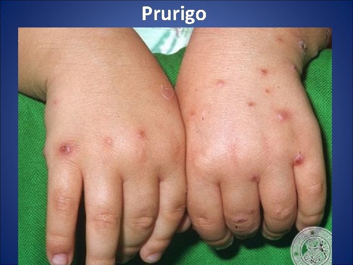 Prurigo 