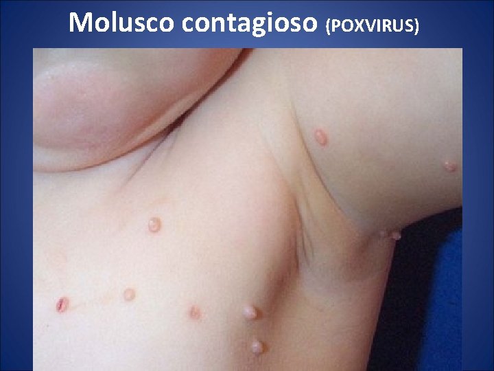 Molusco contagioso (POXVIRUS) 
