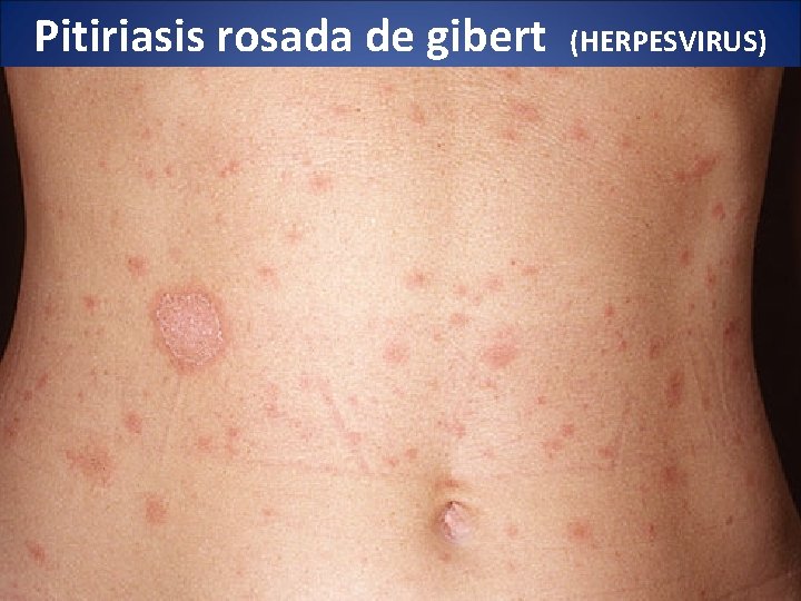 Pitiriasis rosada de gibert (HERPESVIRUS) 
