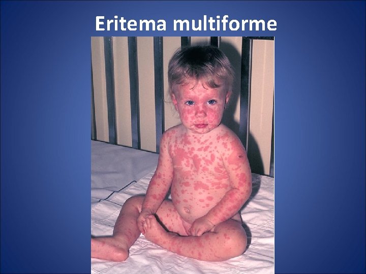 Eritema multiforme 