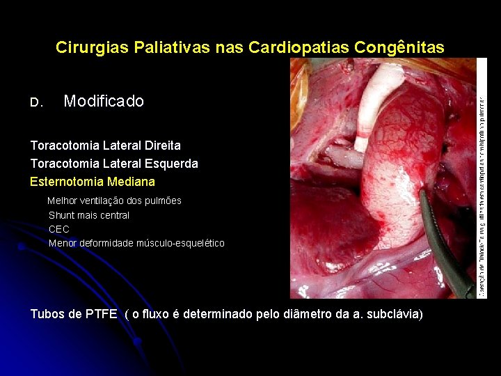 Cirurgias Paliativas nas Cardiopatias Congênitas D. Modificado Toracotomia Lateral Direita Toracotomia Lateral Esquerda Esternotomia