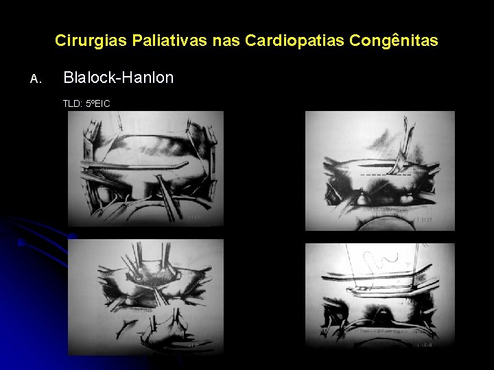 Cirurgias Paliativas nas Cardiopatias Congênitas A. Blalock-Hanlon TLD: 5ºEIC 