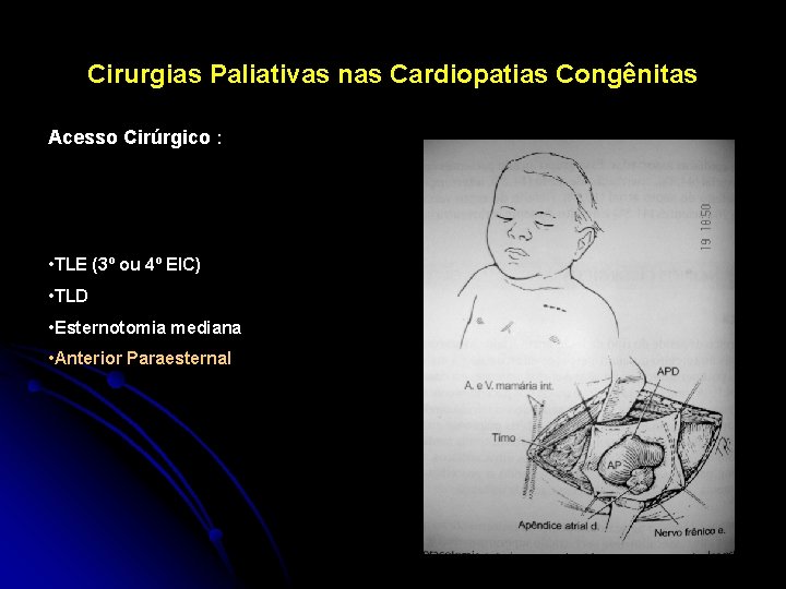 Cirurgias Paliativas nas Cardiopatias Congênitas Acesso Cirúrgico : • TLE (3º ou 4º EIC)