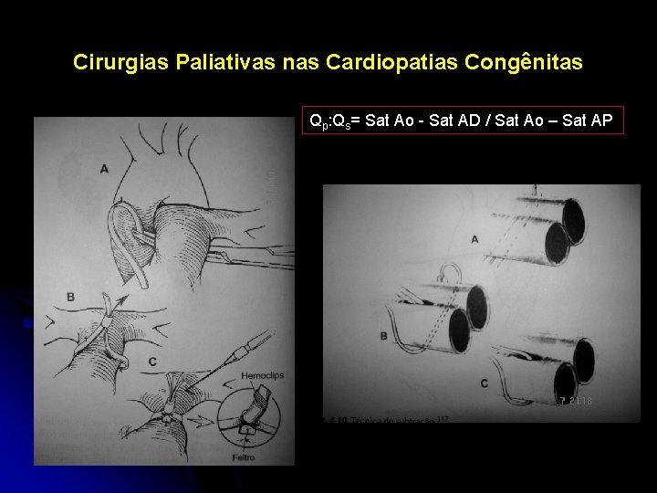 Cirurgias Paliativas nas Cardiopatias Congênitas Qp: Qs= Sat Ao - Sat AD / Sat