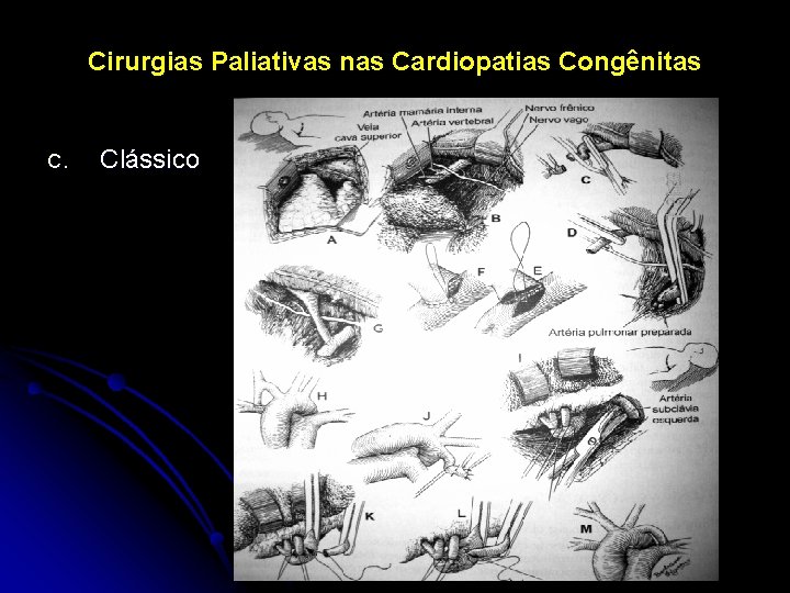 Cirurgias Paliativas nas Cardiopatias Congênitas C. Clássico 