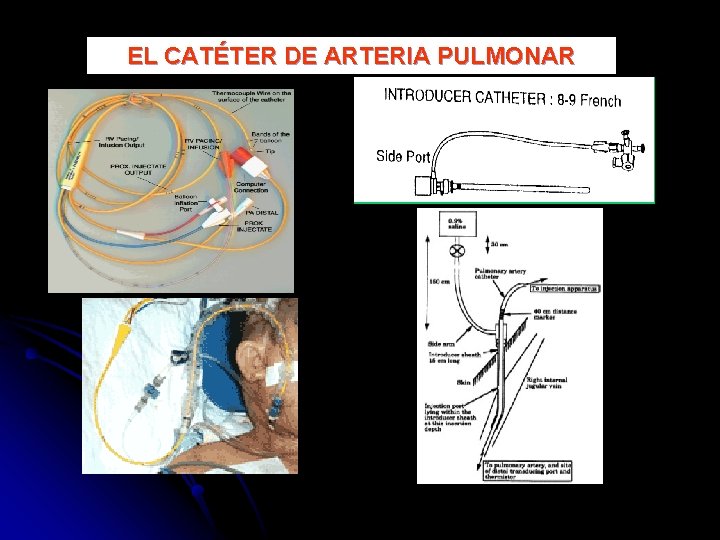 EL CATÉTER DE ARTERIA PULMONAR 