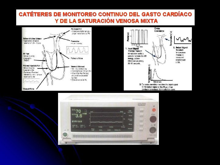 CATÉTERES DE MONITOREO CONTINUO DEL GASTO CARDÍACO Y DE LA SATURACIÓN VENOSA MIXTA 