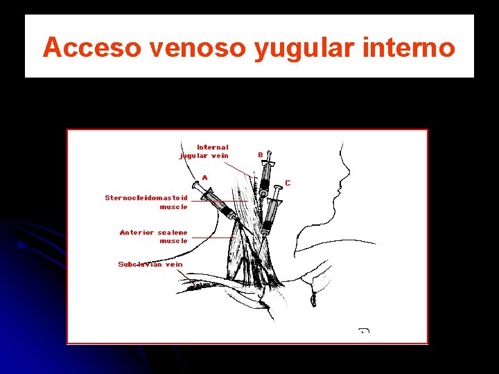 Acceso venoso yugular interno 